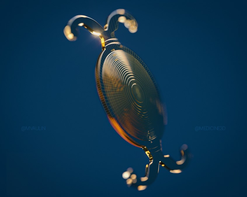 medical illustration of This is a frame from the animation of the PhysIOL FineVision IOL (intraocular lens) product. This 3d model was made for the ESCRS 2020 video presentation. Such a lens is used to replace the lens of the human eye during a phacoemulsification operation.
This lens has some special features, such as a diffraction optics that allows the eye to focus at several focus points at once.
Check out the feature animation in my portfolio.