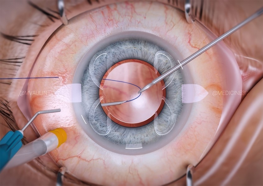 medical illustration of Frame from animation showing the step of ophthalmological operation of intraocular fixation of IOL, a special technique is used to guide the thread through the haptic and fix the lens in an eye that lacks or damages the capillary sac.