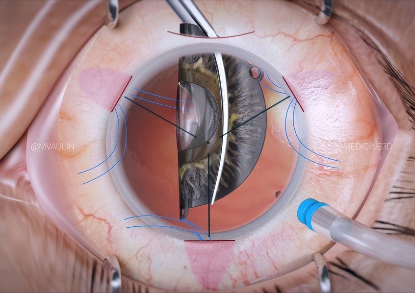 medical illustration of Frame from animation frame showing the stage of an ophthalmological operation to implant an artificial iris in the eye. A special technique is used to place the iris in the eye in a folded state and then straighten it inside the eye for further fixation.