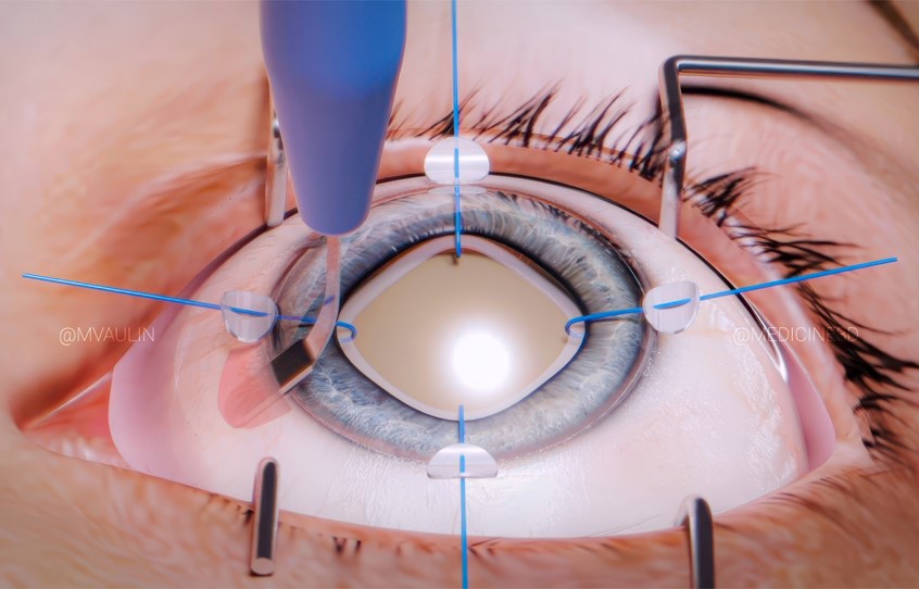 medical illustration of A still frame from the animation showing the stage of formation of the Hoffman pocket, we also see the installed iris retractors, which allow for pupil dilation in case of weakness of the ciliary muscles, in the direction through the created pockets causing the IOL to be sutured.
