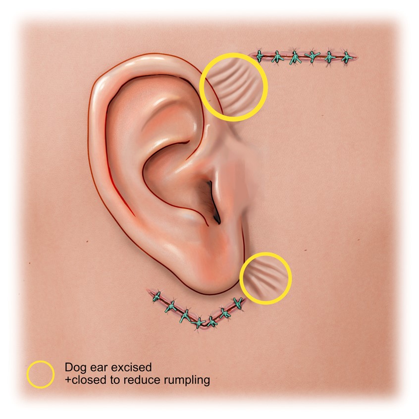 medical illustration of A series of illustrations created for a journal publication on a method of suturing in the field of aesthetic medicine.
Illustration presents a problem of