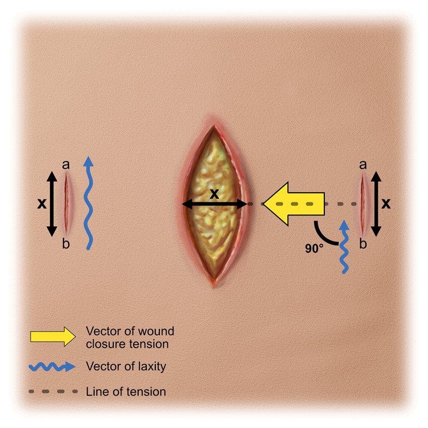 medical illustration of A series of illustrations created for a journal publication on a method of suturing in the field of aesthetic medicine.
Illustration presents a method of suturing of an open incision with additional incisions reducing rumpling of the skin.