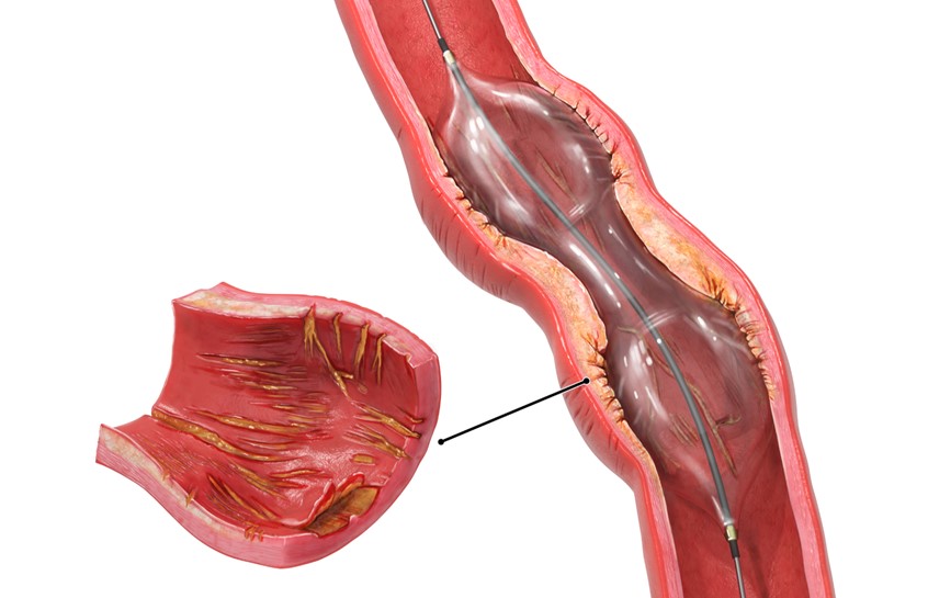 medical illustration of 3D/2D medical Illustration presenting one of the risks during the procedure of angioplasty. The balloon expands unevenly (dog-boning) due thick layer of build-up plaque. The balloon may damage arteries this way.