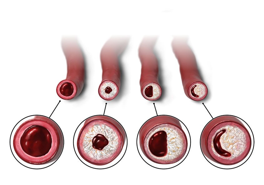 medical illustration of 2D/3D illustration presenting different patterns of calcium sediment build-up in the arteries of patients with atherosclerosis.
From left to right: Healthy artery, Concentric deposit, Eccentric deposit, Nodular deposit.