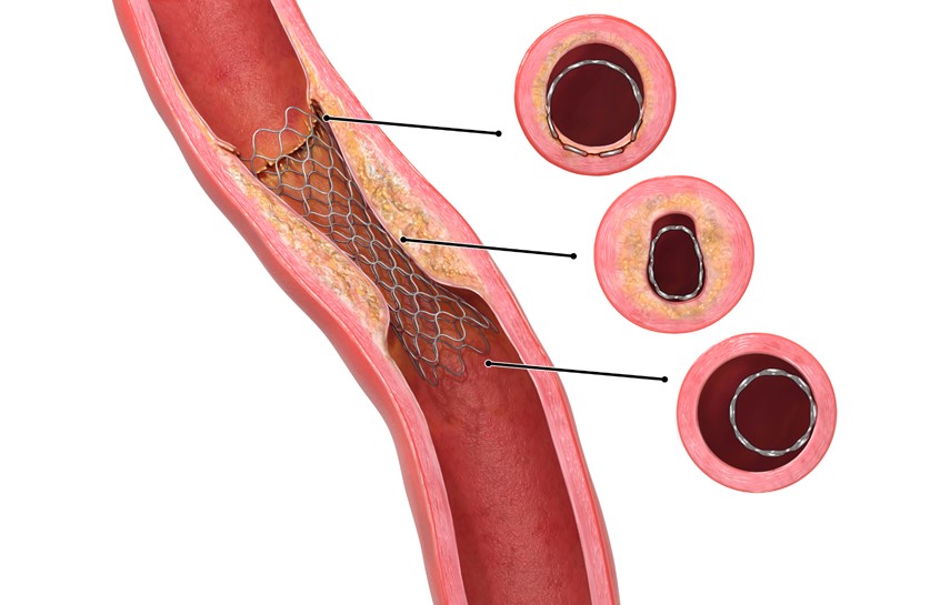medical illustration of 3D/2D medical Illustration presenting risks and potential complications of stent deployment procedure in a peripheral artery.