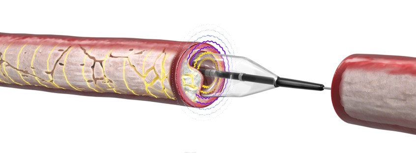medical illustration of 2D/3D illustration depicting how the novel intravascular lithotripsy (IVL) device operates breaking down calcium build-up in the arteries.
Illustration for patient education brochure on client's website.