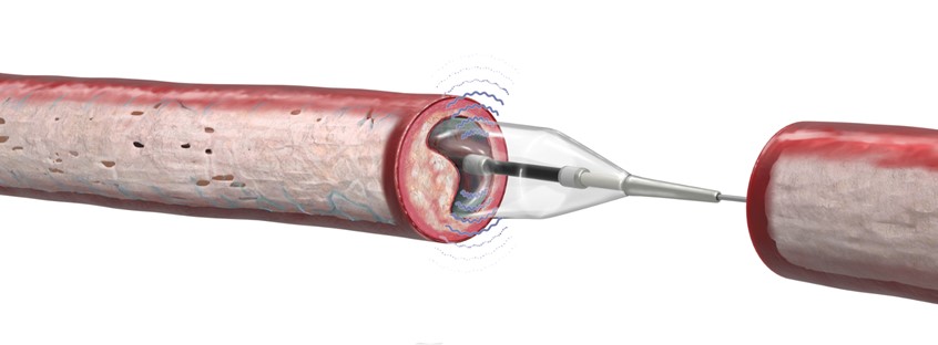 medical illustration of 2D/3D illustration depicting how a intravascular lithotripsy (IVL) device operates breaking down calcium build-up in the arteries.
Comparison of a different model of the device.
Illustration for patient education brochure on client's website.