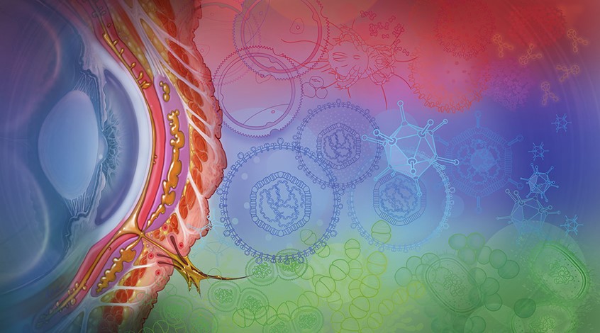 medical illustration of The left side displays a detailed anatomical cross section of an eye, highlighting classic symptoms like conjunctival injection and inflammation. The right side features three distinct color-coded bands with icons representing the primary causes of the condition: red for allergens, blue for viruses, and green for bacteria.