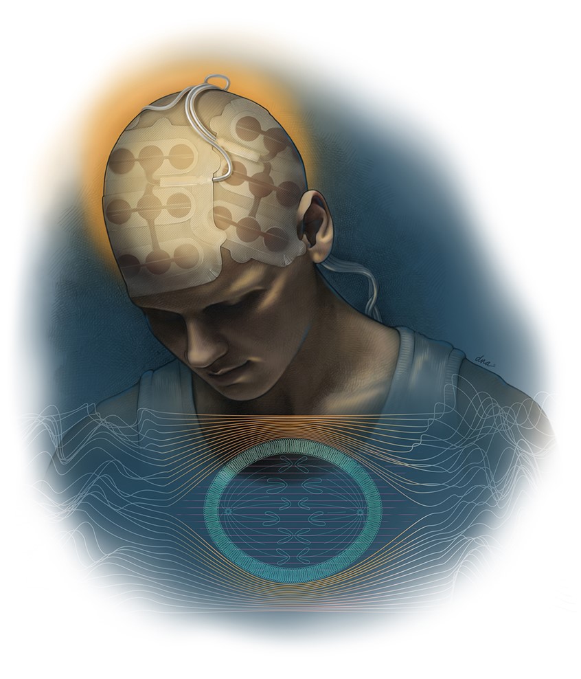 medical illustration of A dual-layered medical illustration showing a patient undergoing magnetic therapy for glioblastoma. The top portion shows a patient profile wearing a sleek cap fitted with small, circular rotating magnets. The bottom portion is a microscopic cutaway showing the tumor cell's structure, where organelles are actively aligning along the magnetic force lines causing them to break apart, and ultimately undergo apoptosis.