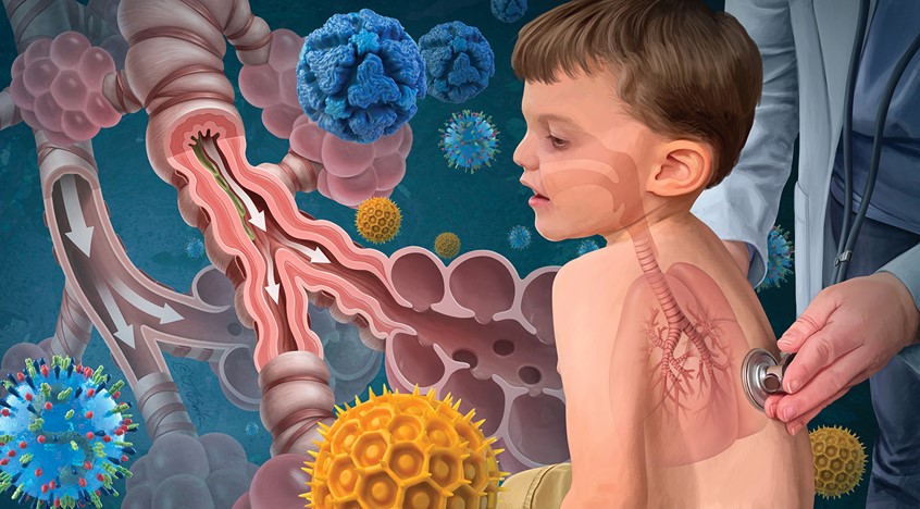 medical illustration of Young boy with physician listening to his labored breathing. Bronchioles comparing open airway to narrowed restricted airway. RSV, Rhinovirus, and pollen floating about.