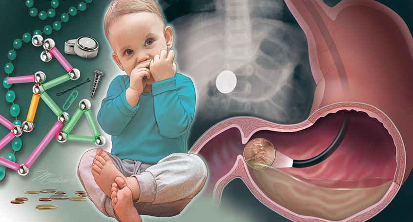 medical illustration of The illustration portrays a toddler putting something in his mouth. The left side of the illustration depicts a grouping of harmful objects and toys. The right side of the coposition depicts a stomach that has a gastric endoscope identifying a penny lodged in the pyloric region. In the background there is an abdominal x-ray showing a stomach with a foreign object inside.