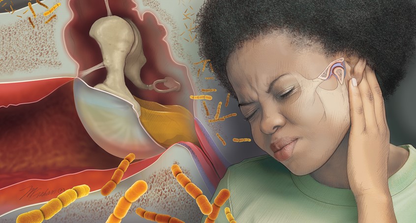 medical illustration of Woman has her hand held up to her ear indicating that she has ear pain. Various causes of pain in the ear are illustrated; otitis external, otitis media, TMJ. Bacteria are seen cascading across the composition.