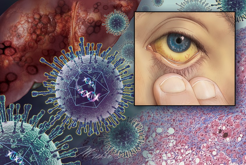 medical illustration of This image depicts a diseased liver and hepatitis virus with a jauntice eye. There is also a histology section of fatty liver disease shown in the illustration.