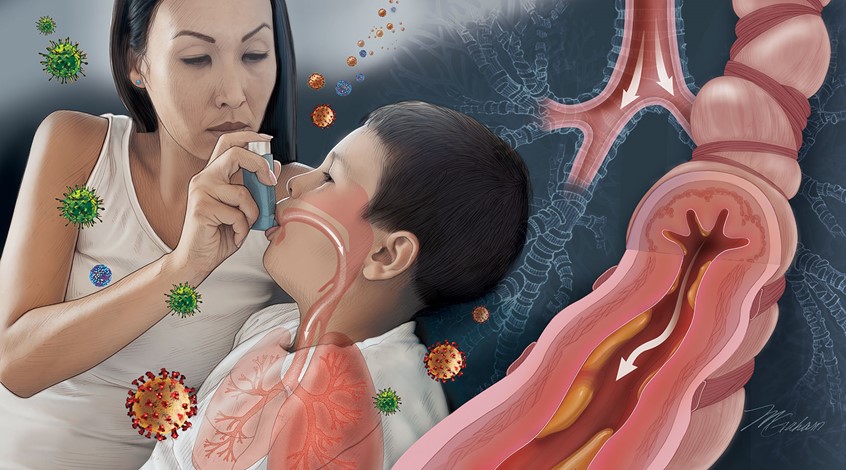medical illustration of A mother is administering an inhaler medication to a young boy. An asthmatic bronchi showing muscle constriction, inflammation and excessive mucus secretion is seen on the right. An arrow is shown representing difficult airflow. The background depicts a normal bronchi with easy airflow represented by arrows.
