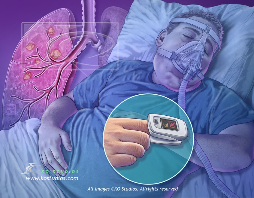 medical illustration of Respiratory Diseases; Asthma, Chronic obstructive pulmonary disease (COPD), Chronic bronchitis, Emphysema, Lung cancer, Cystic fibrosis and Bronchiectasis - is a condition in which patients develop abnormally dilated bronchial tubes, Pneumonia and walking Pneumonia, Pleural effusion, COVID-19, Obesity