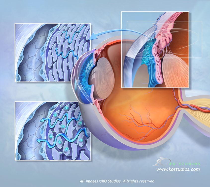 medical illustration of Glaucoma affects the iris primarily in angle-closure glaucoma, where the iris bulges forward, physically blocking the eye's drainage angle, causing rapid pressure buildup, redness, pain, and vision loss. In pigmentary glaucoma, pigment flakes off the iris, clogging the drainage system. While open-angle glaucoma doesn't physically alter the iris, severe cases can lead to pupil dilation, potentially affecting iris function.