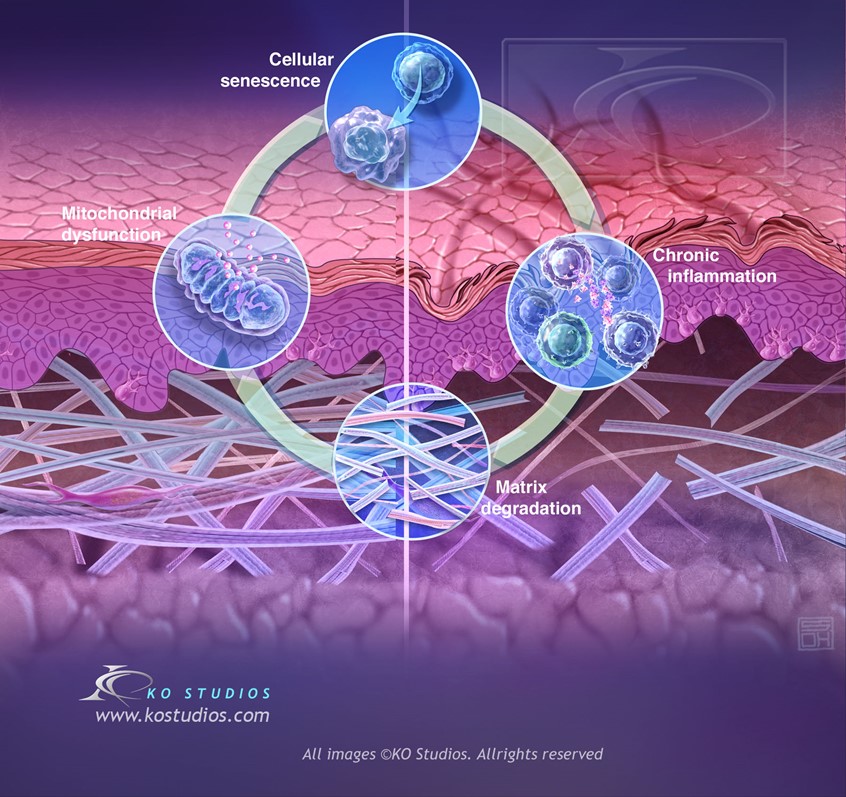 medical illustration of Inflammaging is chronic inflammation that develops throughout the body as a person ages, accelerating biological aging and increasing the risk of age-related diseases. Inflammaging is persistent and silent. The immune system remains on high alert over time, gradually damaging healthy cells and tissues.