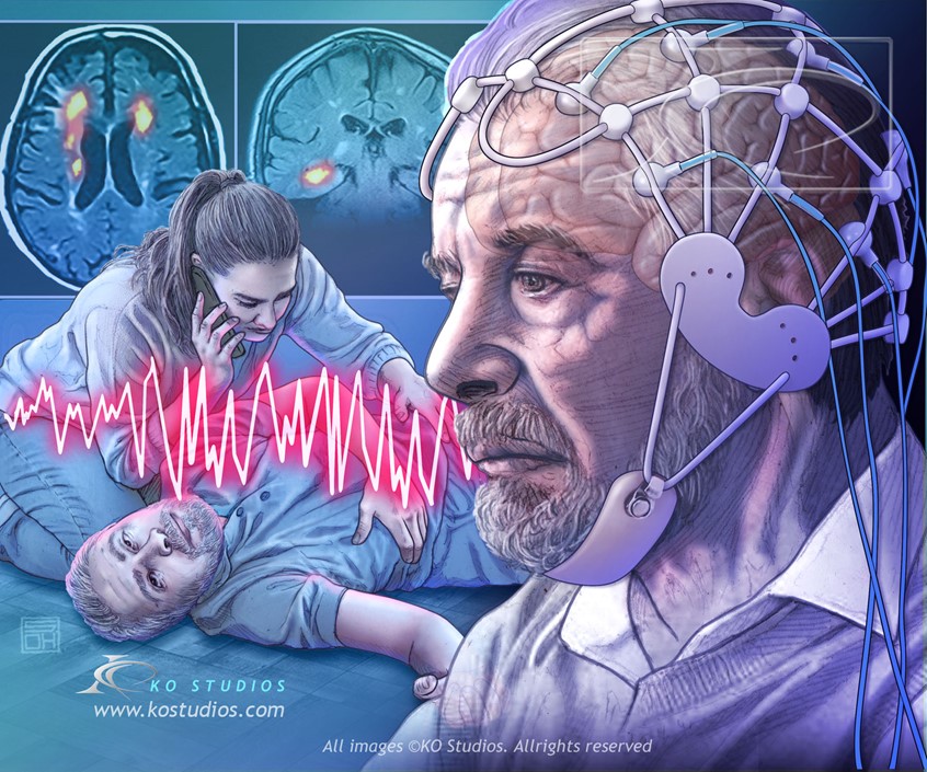 medical illustration of A seizure disorder, or epilepsy, is a medical condition marked by recurrent, unprovoked surges of electrical activity in the brain that disrupt normal function. Generalized Seizures, Focal Seizures, Absence Seizures, and Tonic-Clonic Seizures are four types of seizures in this category.
