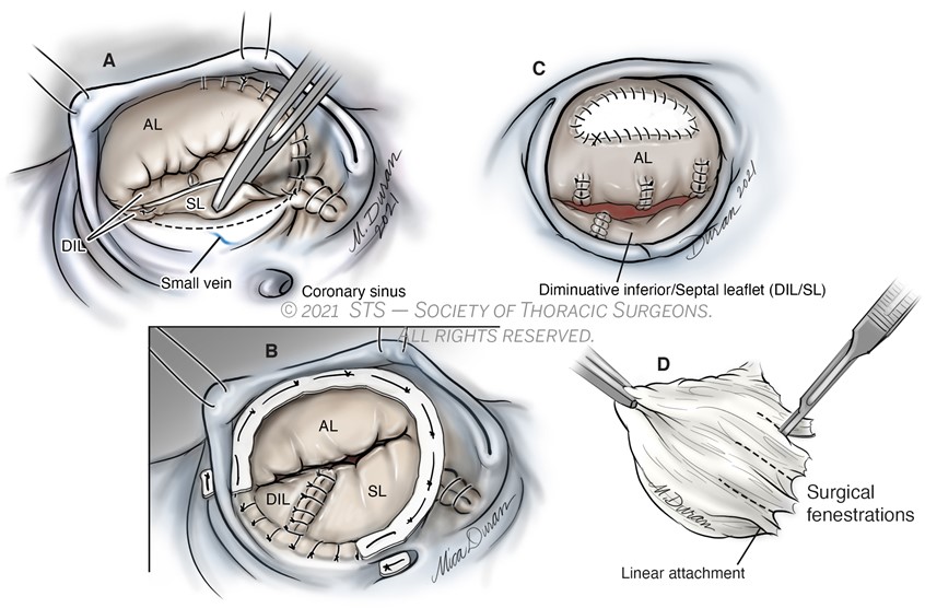 medical illustration of Created for an illustrated e-Textbook for the Society of Thoracic Surgeons, in conjunction with Anatomize Studios. One in series regarding Surgical Management of Ebstein Malformation of the Tricuspid Valve