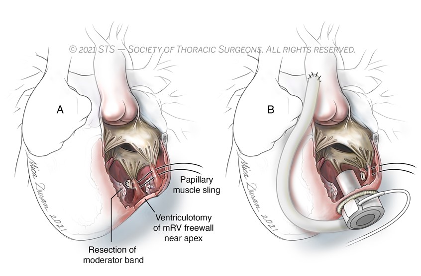medical illustration of Created for an illustrated e-Textbook for the Society of Thoracic Surgeons, in conjunction with Anatomize Studios. One in a series regarding congenitally corrected transposition of the Great Arteries (ccTGA).