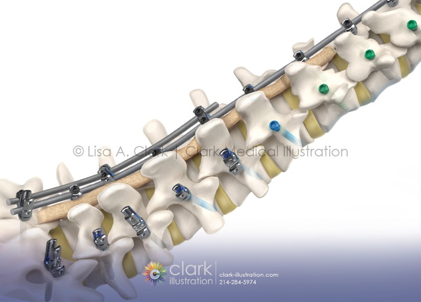 medical illustration of Illustration of Medtronic's ModuleX spinal system for marketing and education materials. The modular platform enables surgeons to select optimal screw shanks and heads during surgery based on the procedure and patient anatomy.