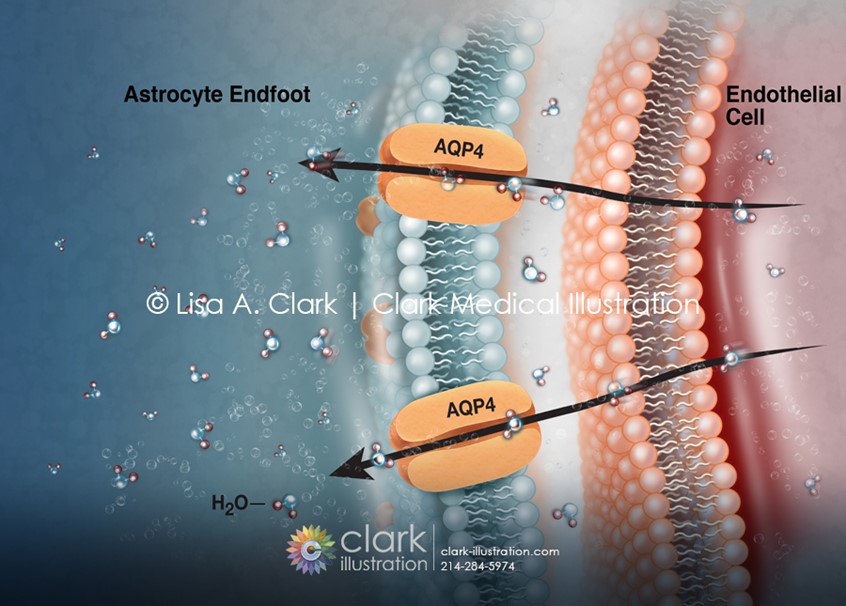medical illustration of During a stroke, the brain is starved of oxygen, triggering a chain reaction that causes water to flood brain cells. This happens through Aquaporin-4 (AQP4) channels, found on astrocyte cells lining the brain's protective barrier. Left unchecked, the buildup of fluid increases pressure inside the skull and can cause permanent brain damage. This illustration was created for an investigational IV drug that aims to block these AQP4 channels and prevent dangerous brain swelling.