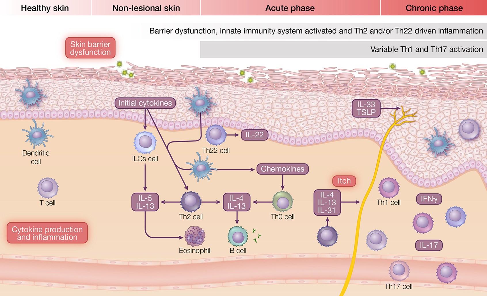 Pathogenesis and Mechanisms of Atopic Dermatitis Illustration by